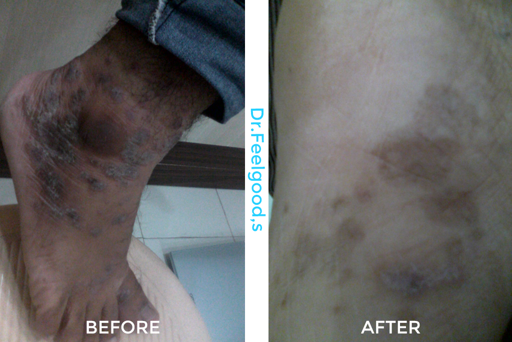 new-PSORIASIS
