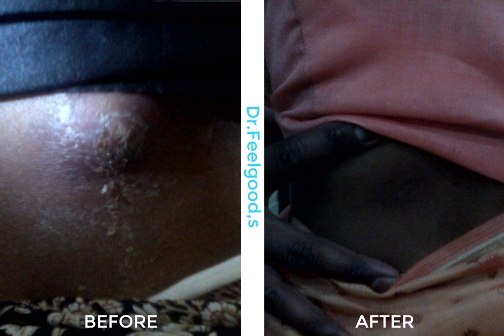 new-recurrent-abscess